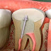 Toxic Teeth: How Root Canal Procedures Dramatically Increase Your Risk of Chronic Disease