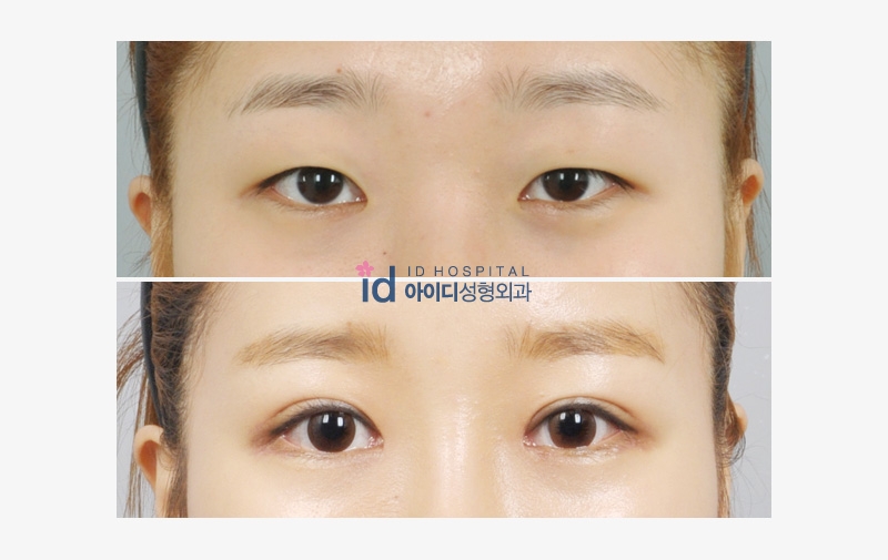 ID Hospital Korea Is it possible to have natural looking double eye