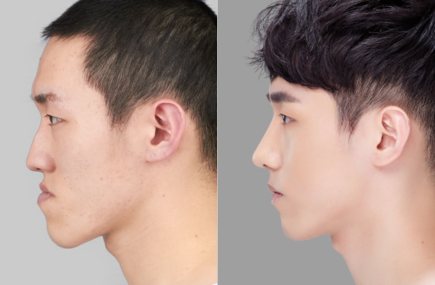 [Before and After Photos] Korean Plastic Surgery for Men 짱이뻐!