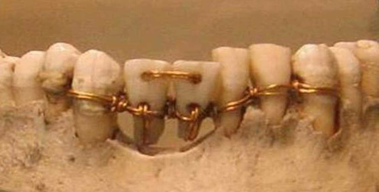 Arqueólogos descubren dentaduras postizas medievales hechas con dientes de individuos fallecidos
