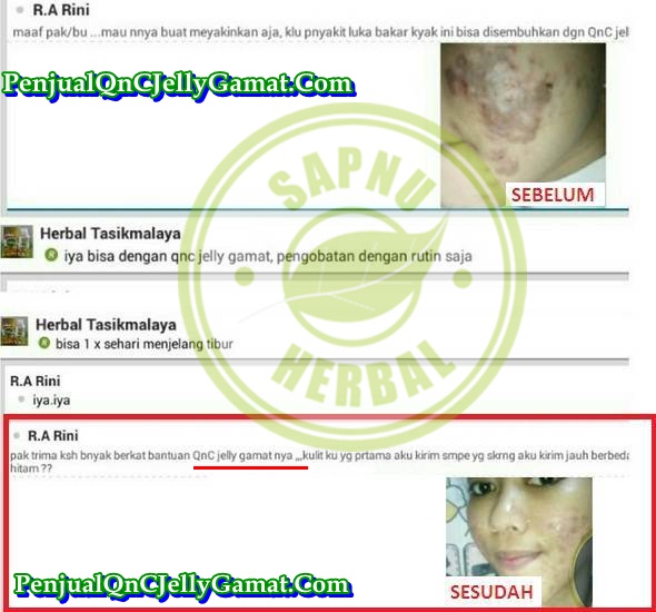 Obat Eksim Kering Dan Basah yang 100% TERBUKTI MANJUR !! Obat Eksim Kering Dan Basah yang 100% TERBUKTI MANJUR !!