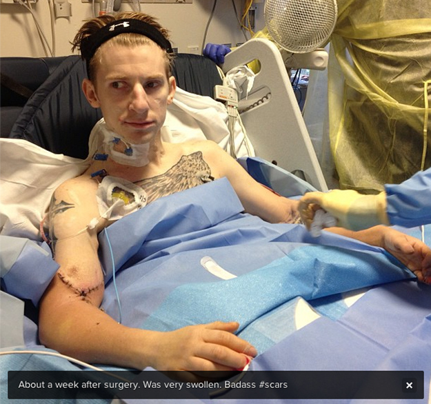 prostituée amputée