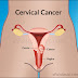 8 Risk of Womb Cancer for Women