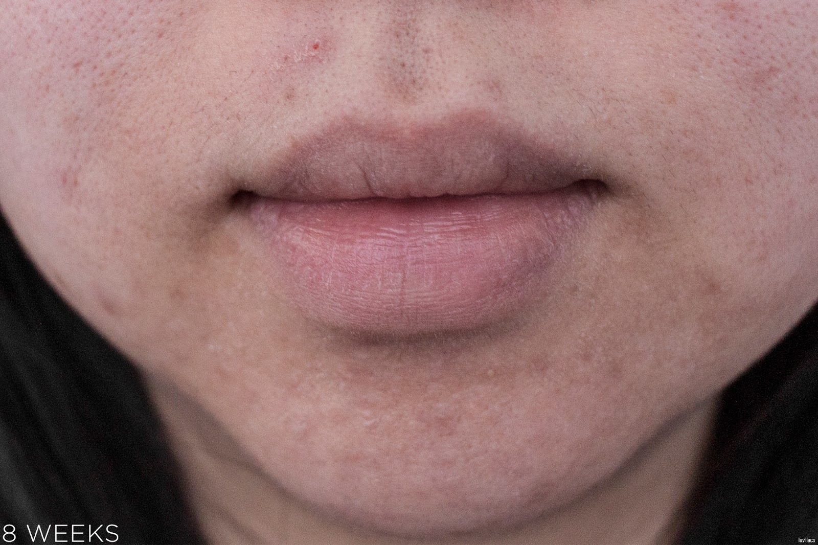 tria Hair Removal Laser Facial Hair 8 Weeks Closeup