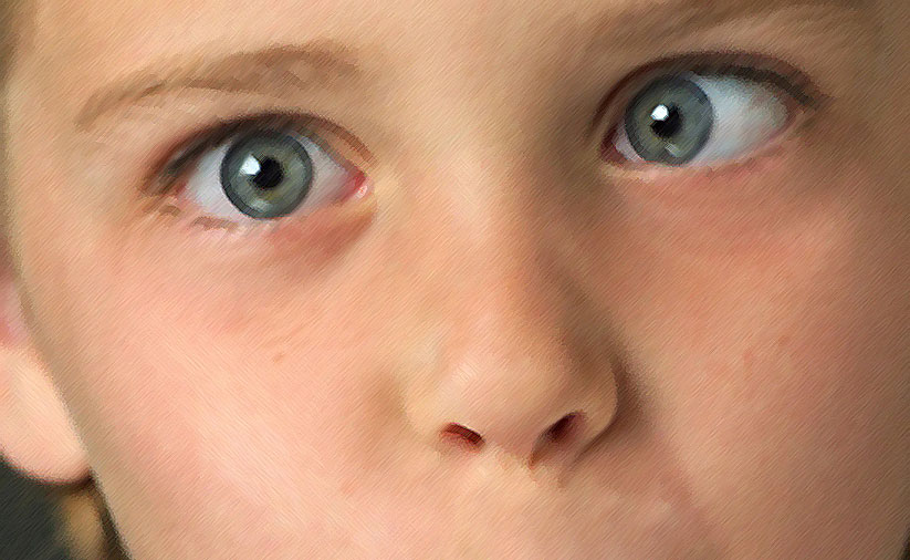 Diivine Opticians squint-eye-treatment-strabismus-crossed-eye-treatment-without-surgery