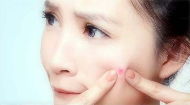 Menghilangkan Bekas Jerawat Secara Alami