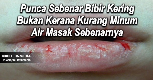 Rawatan Gula Batu Untuk Bibir Kering: Panduan Sebenar Rawatan Gula Batu Untuk Bibir Kering: Panduan Sebenar