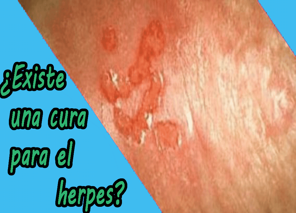 herpes genital causas sintomas herpes genital causas sintomas