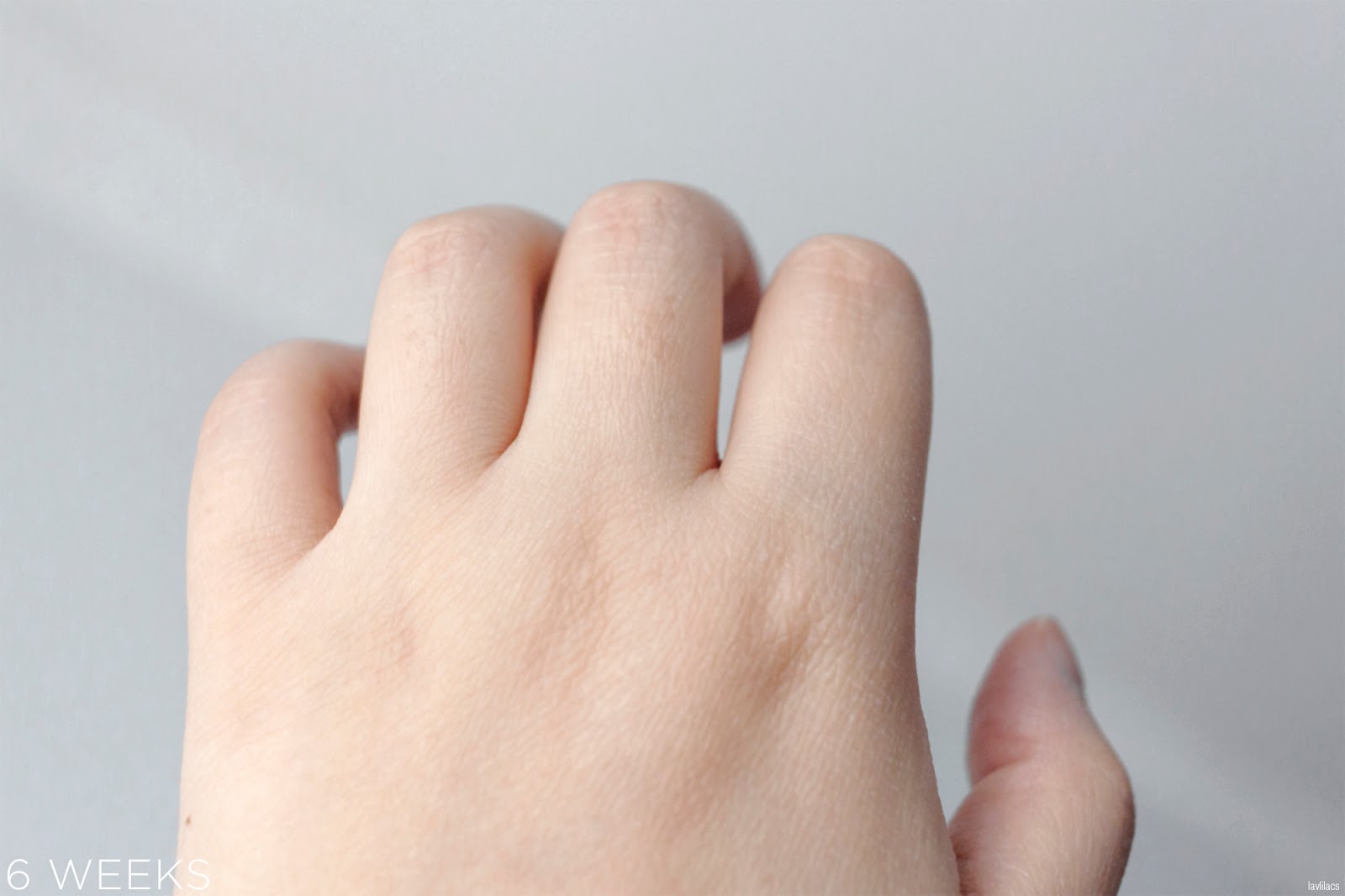 tria Hair Removal Laser Knuckle Hair 6 Weeks