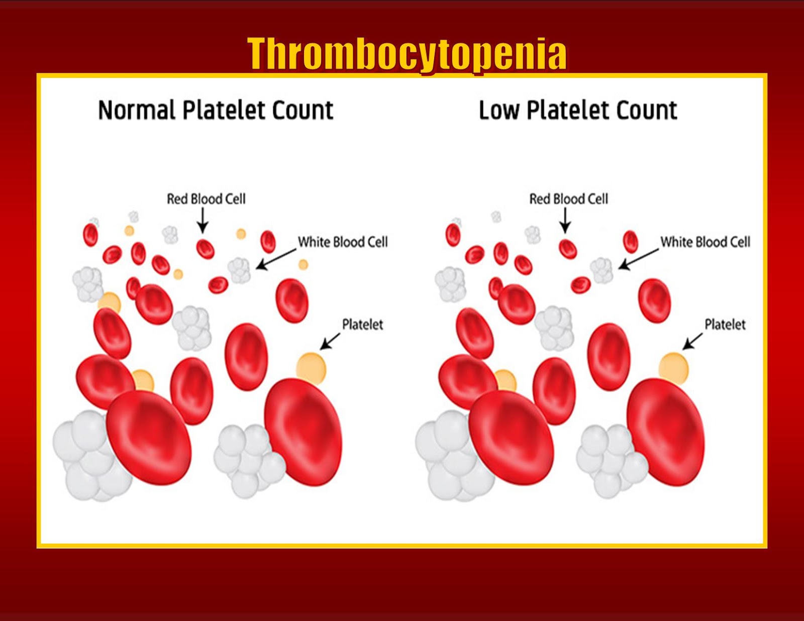 Thrombocytopenia