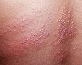 Έρπης ζωστήρας Όλα όσα θέλετε να ξέρετε