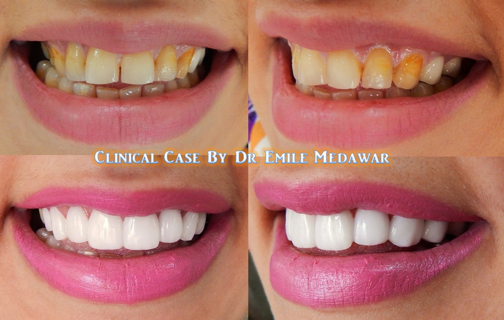 Smile Beirut, Dr Emile Medawar, 00961 3 379355 Porcelain Ceramic