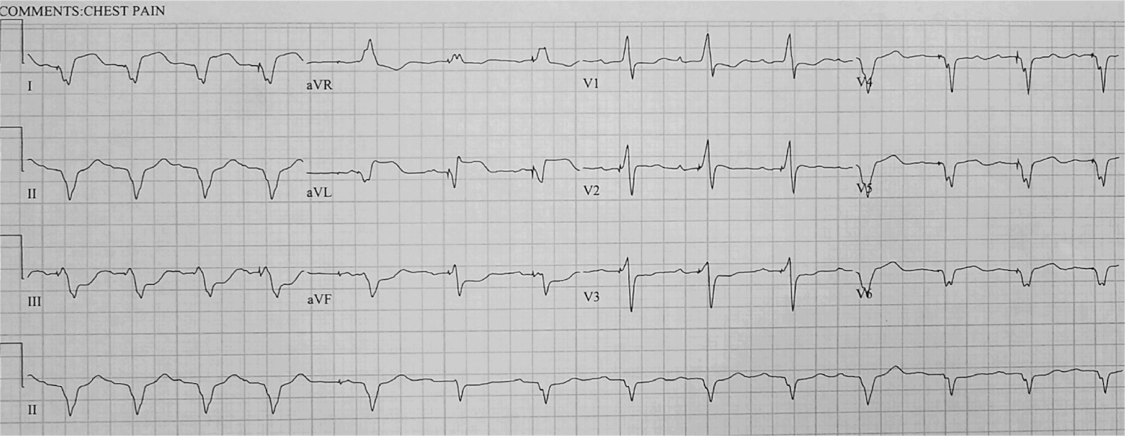 Dr. Smith's ECG Blog Chest pain, Ventricular Paced Rhythm, and a