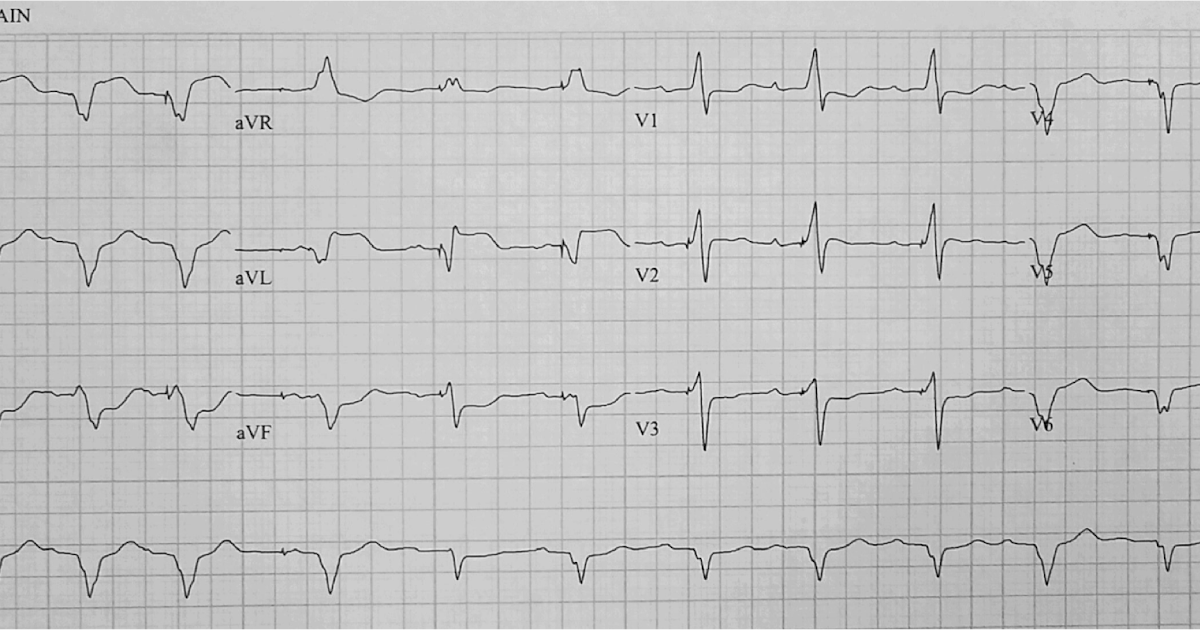 Dr. Smith's ECG Blog Chest pain, Ventricular Paced Rhythm, and a Completely Normal Angiogram 3