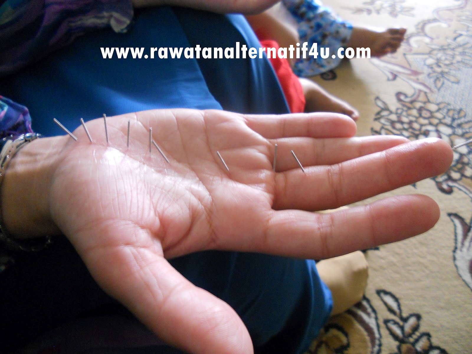 Merawat masalah jantung dengan rawatan akupunktur tangan 