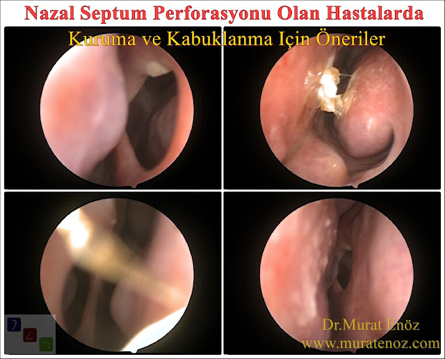 Nazal septum perforasyonu - Nazal septum perforasyonu için ilaç - Septumperforasyonu tedavisi - Septum perforasyonlarında burun kuruluğu ve burun içi kabuklanma için önlemler - Septum perforasyonu ameliyatı olanlar - Septum perforasyonu olanlar - Burunda delik oluşumu - Burun duvarında delik