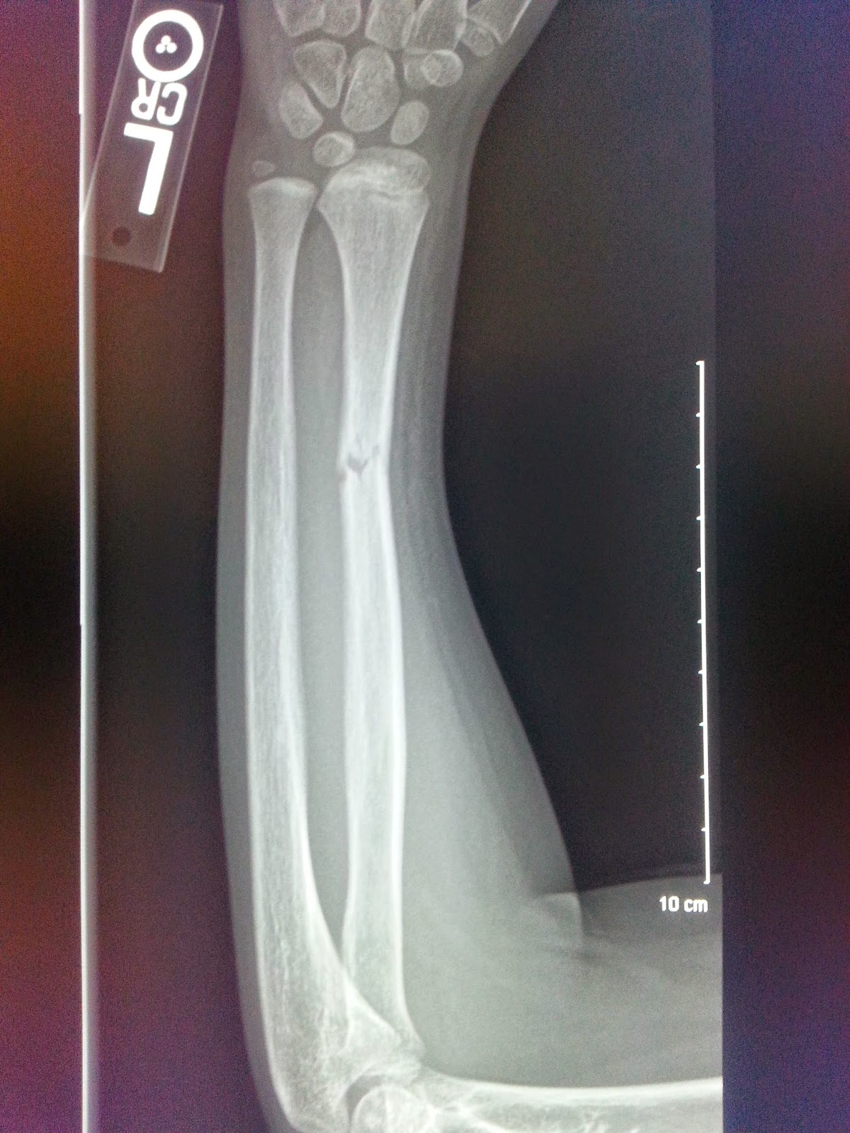 greenstick fracture greenstick fracture