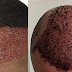 hair transplant in hindi