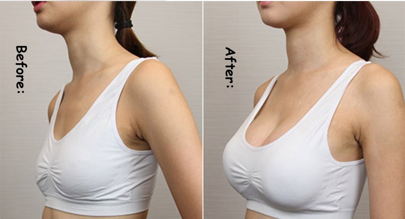 Breast Care Surgery