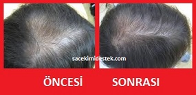 saç mezoterapisi öncesi ve sonrası 19