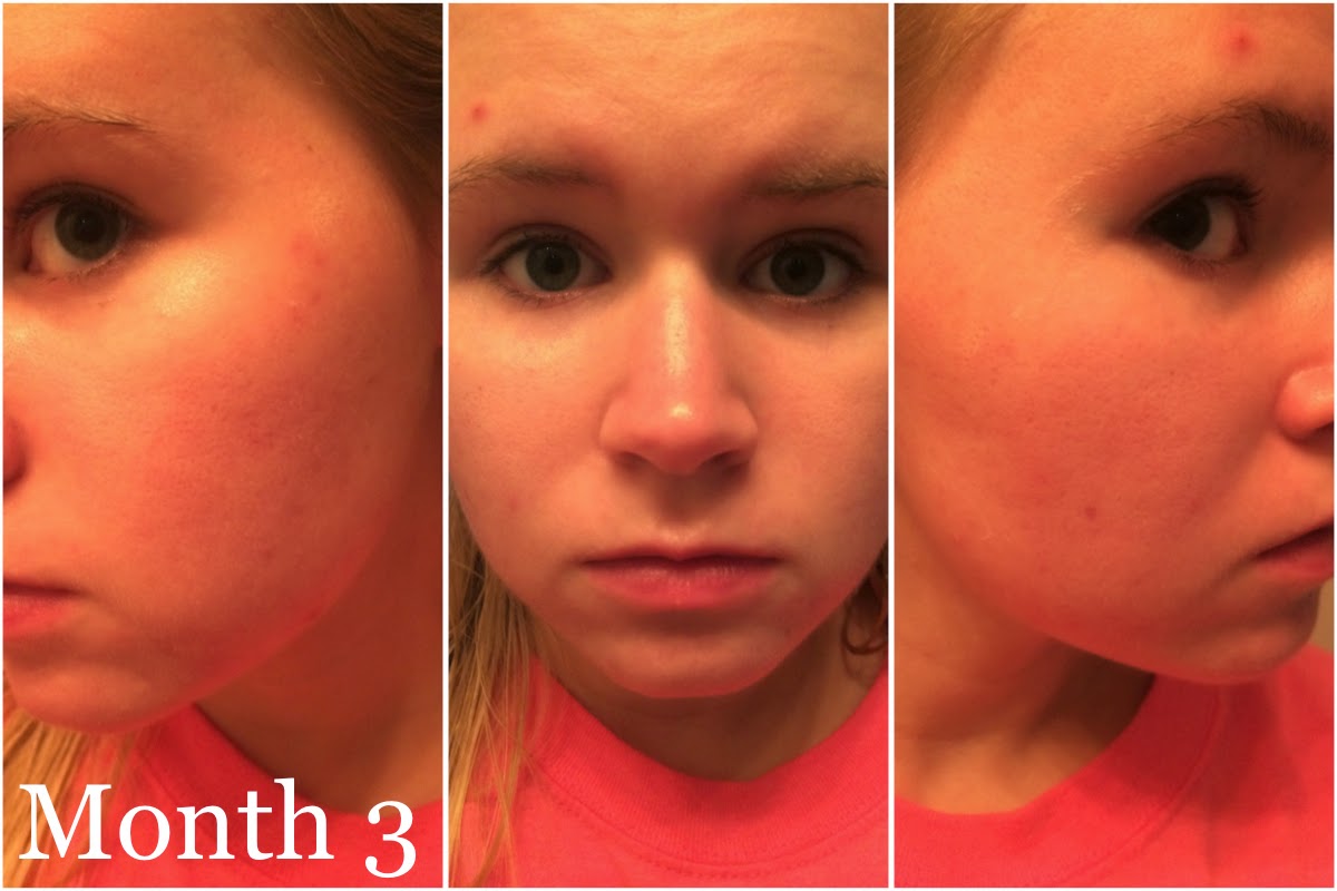 Buy accutane ireland
