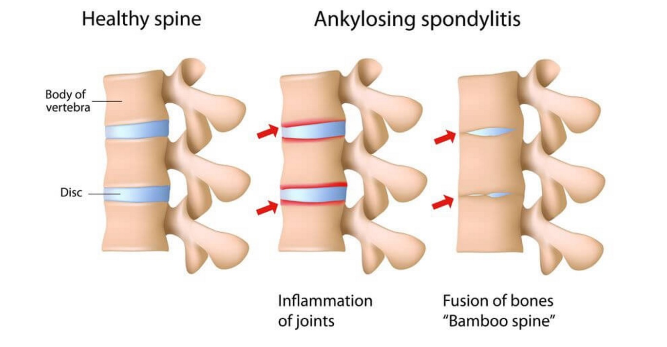 спондилоартроз th11. спондилоартроз спондилоартрит. болезнь бехтерева шейного отдела. диагностика анкилозирующего спондилита болезни бехтерева. спондилит болезнь бехтерева.