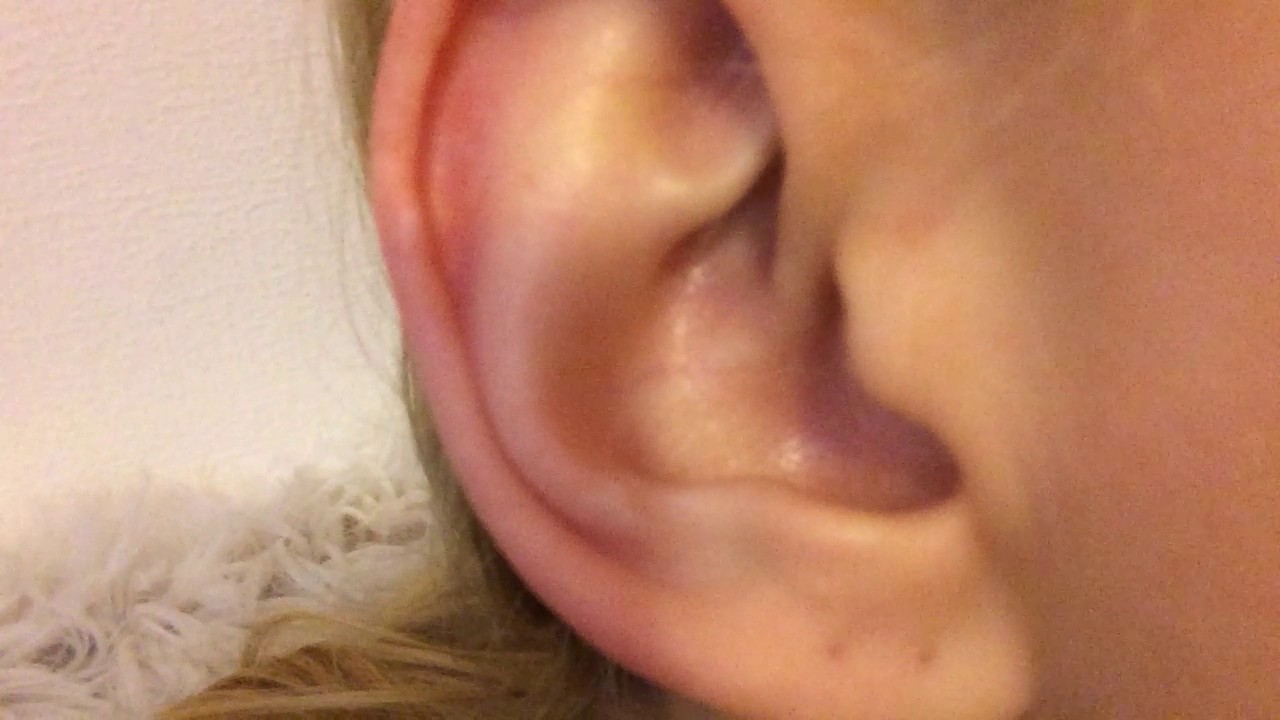Ear Popping; Ear pressure tension signs and symptoms