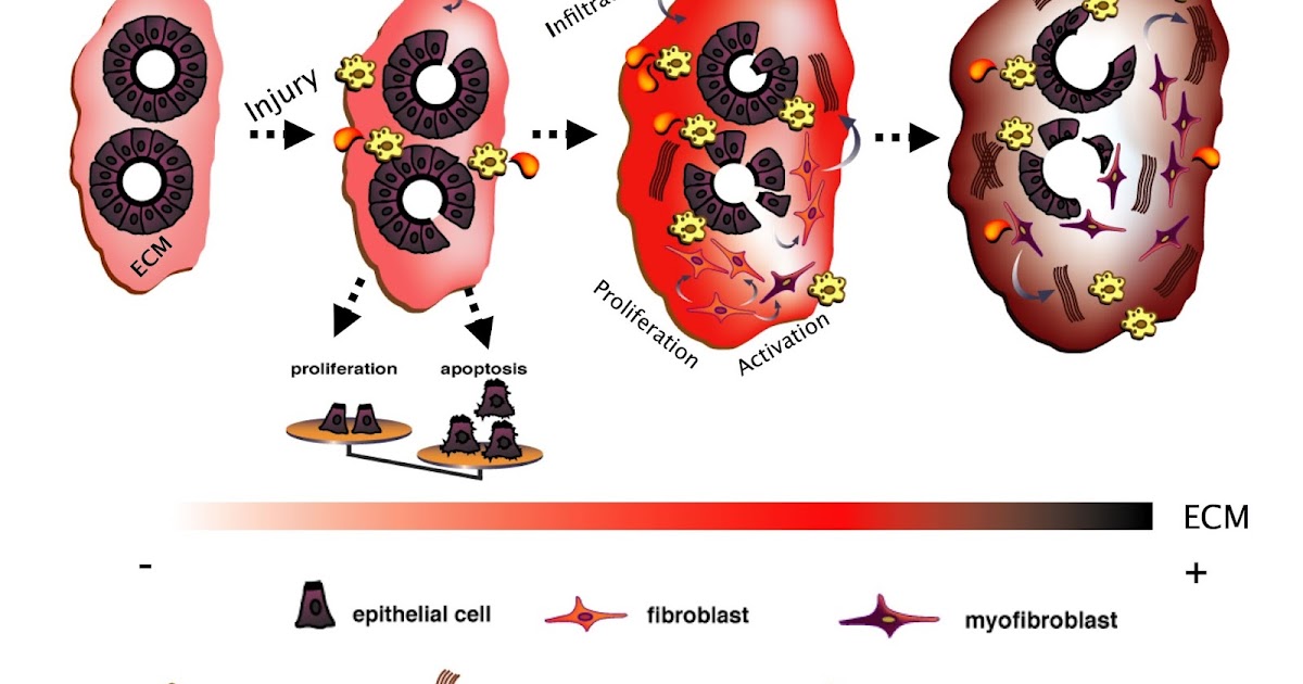 treatment for kidney disease Can Renal Fibrosis be Reversed?