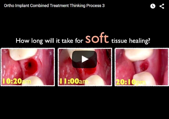 ORTHO IMPLANT Combined Treatment Thinking Process