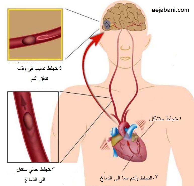 السكتة الدماغية