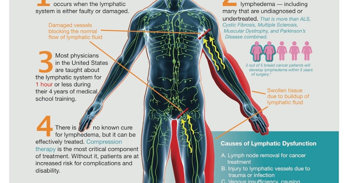 S'informer sur le lymphoedème: Les 3 stades du lymphoedème