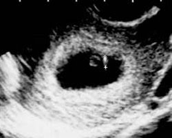 6 haftalık gebelik görüntüsü