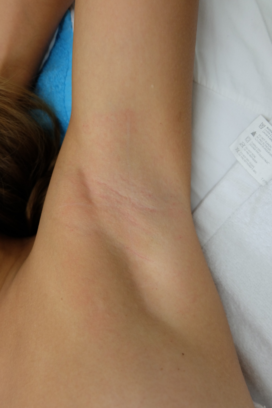 revlite laser underarm