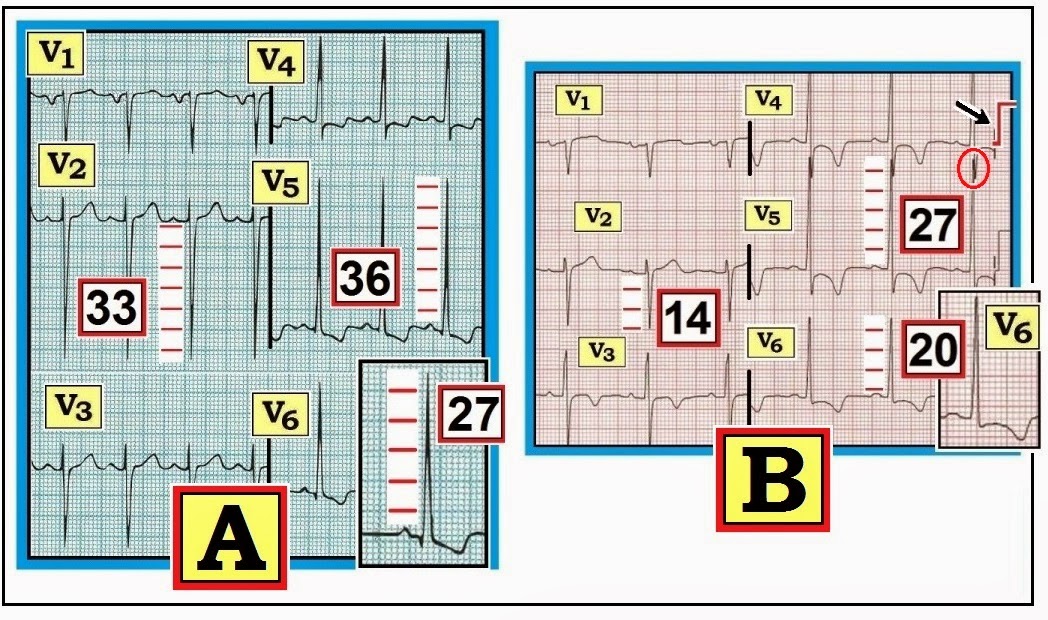 ECG Interpretation ECG Blog 92 (Basic Concepts5) LVH