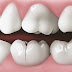 Bọc răng sứ cho răng bị ngả màu giá bao nhiêu ?