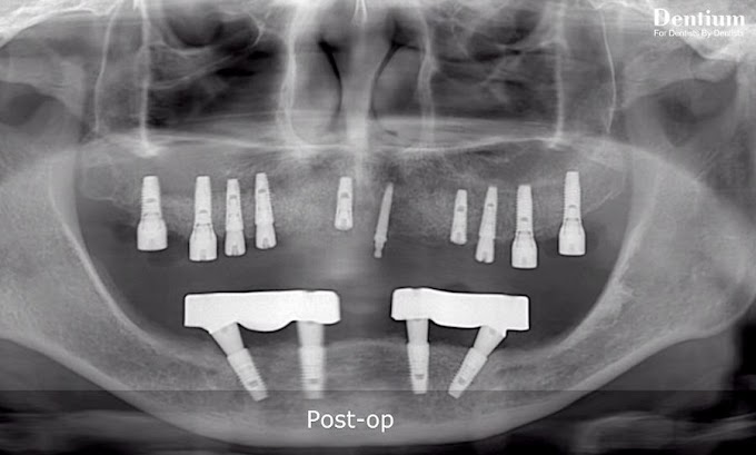IMPLANTOLOGY: Full mouth implantation with GBR on edentulous maxilla - CLINICAL CASE