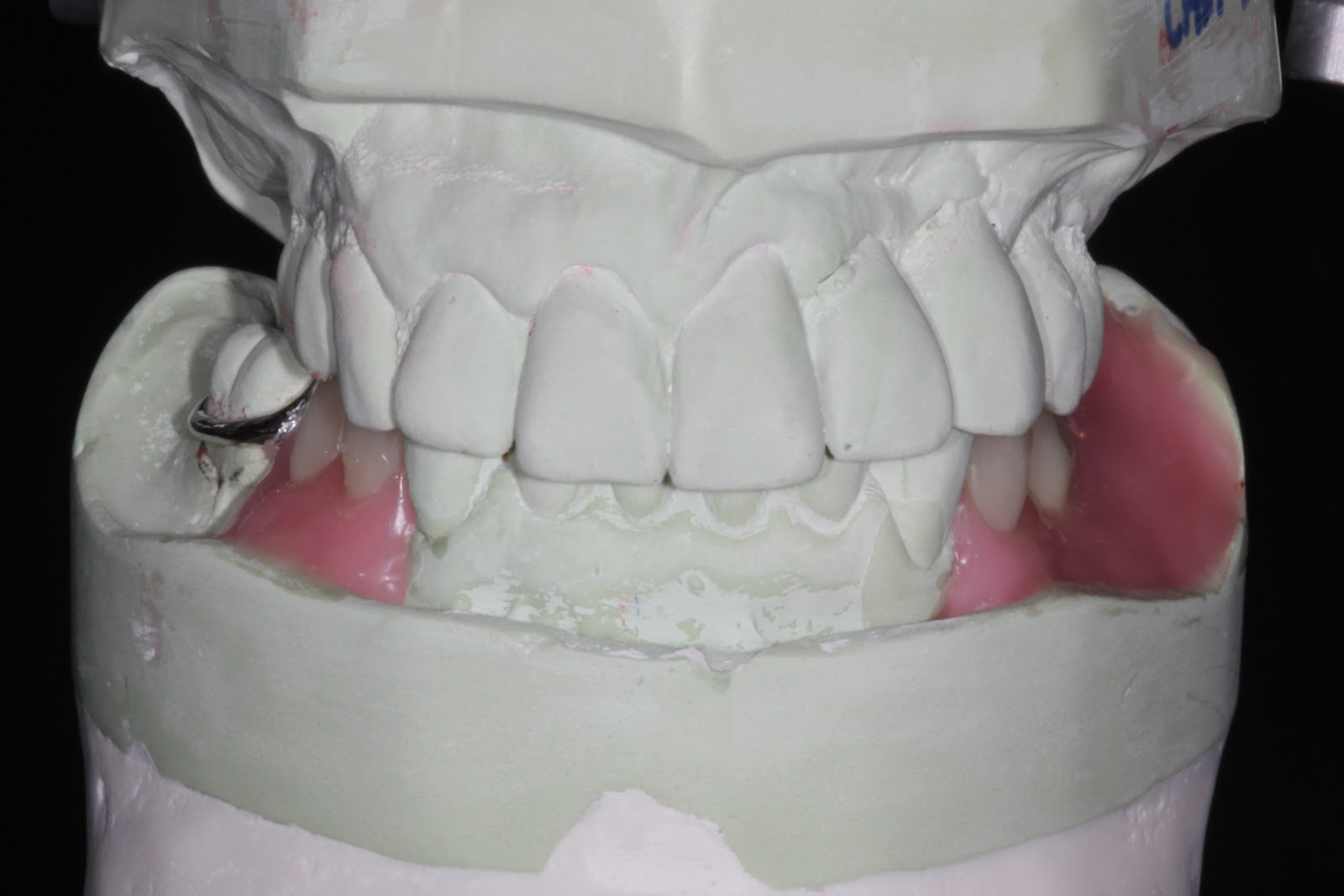 Boise Idaho Prosthodontics: Semi-Precision attachment RPD - 3 different ...