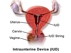 Intrauterine Device, IUD