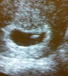 7w2d ultrasound