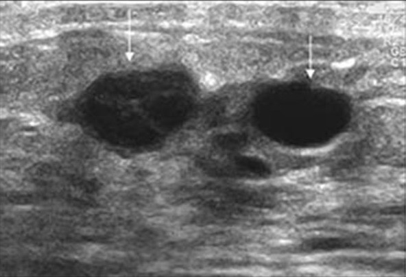 Breast Ultrasound Cancer vs Benign  Cancer OZ