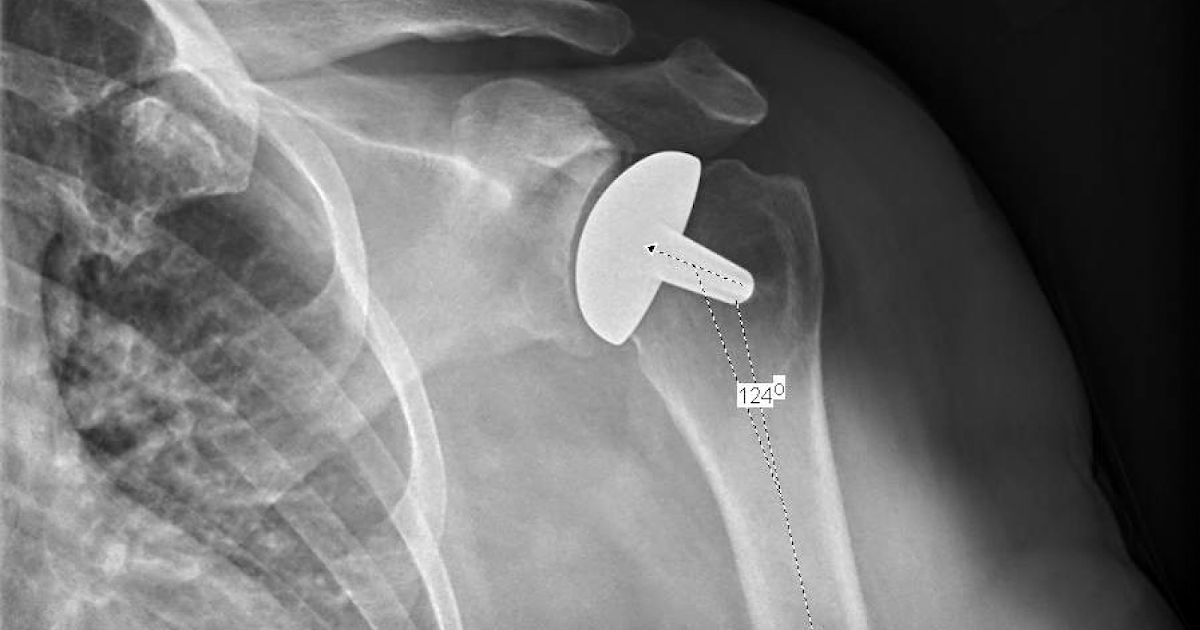 Shoulder and Elbow Surgery Does a stemless shoulder arthroplasty offer