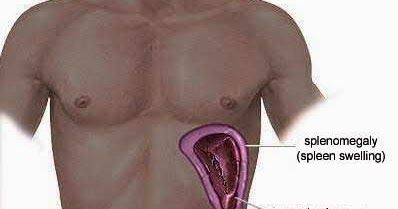 NATURAL TIPS FOR ENLARGED SPLEEN - Natural Fitness Tips