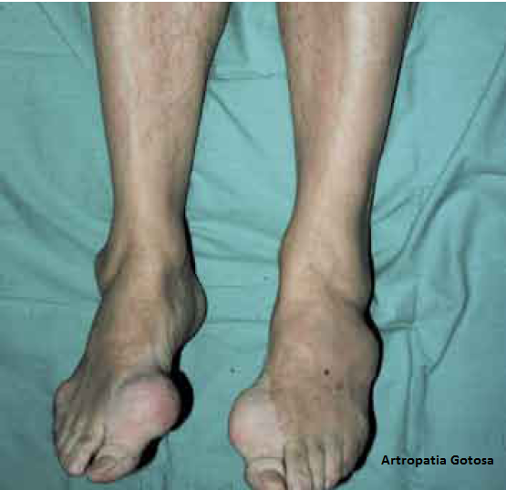 Resúmenes, Clínica Medica Gota