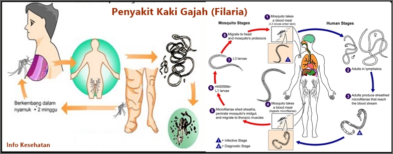 Penyebab Penyakit Kaki Gajah (Filaria) Serta Cara Mencegahnya