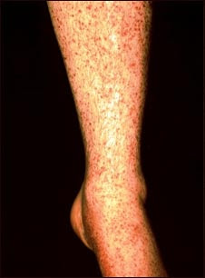 Medical Lecture Notes Online: SYSTEMIC VASCULITIS