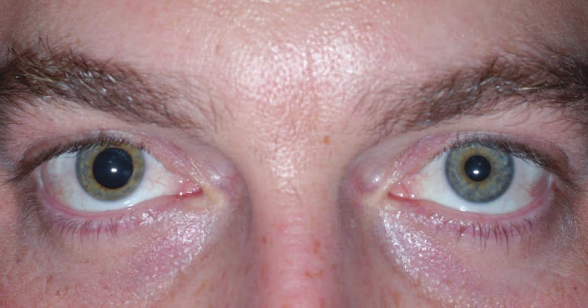 Study Medical Photos Anisocoria