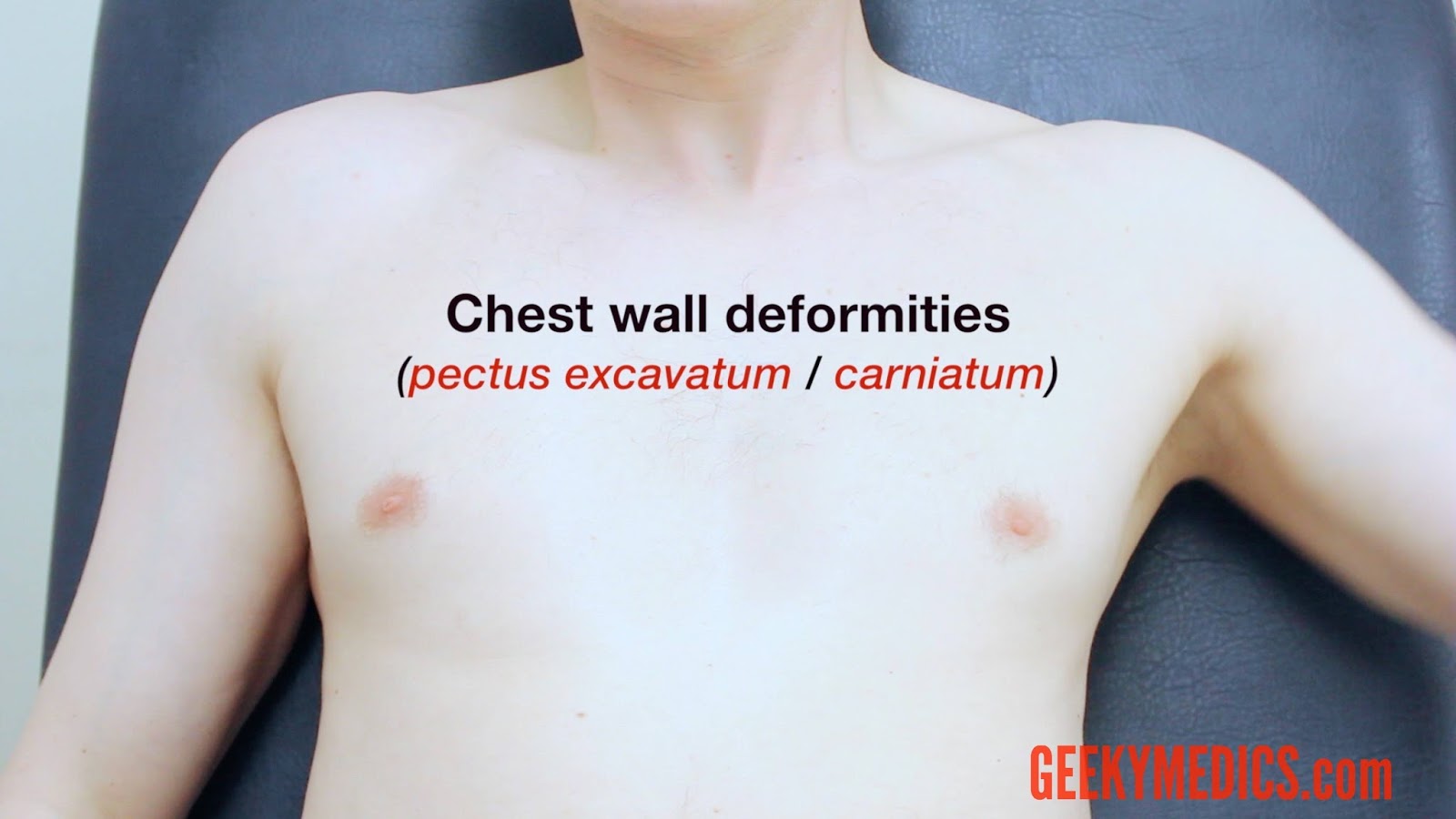 Cheat wall deformity