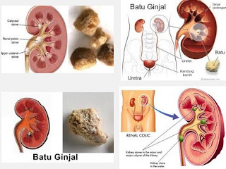 Obat Untuk Batu Ginjal Tanpa Operasi