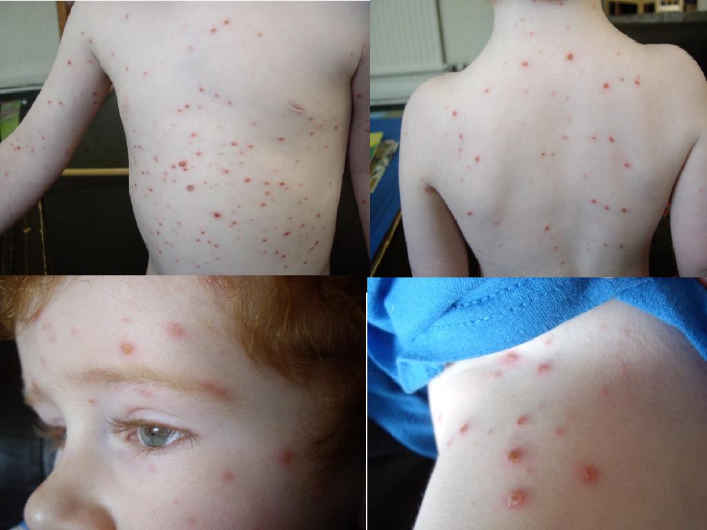 The Brick Castle Chicken Pox for Beginners....