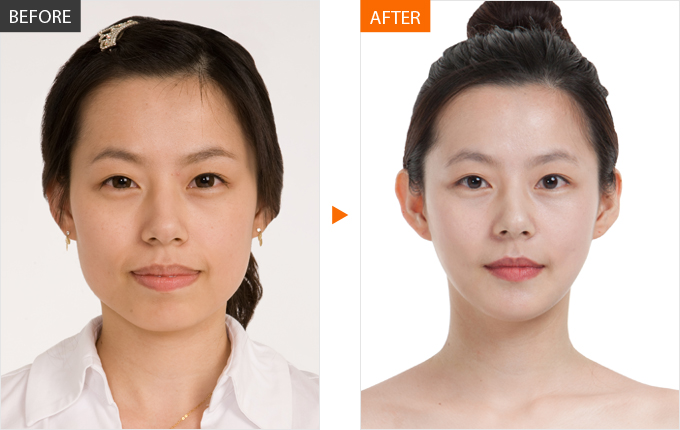 Ботокс корея. Ботокс корея